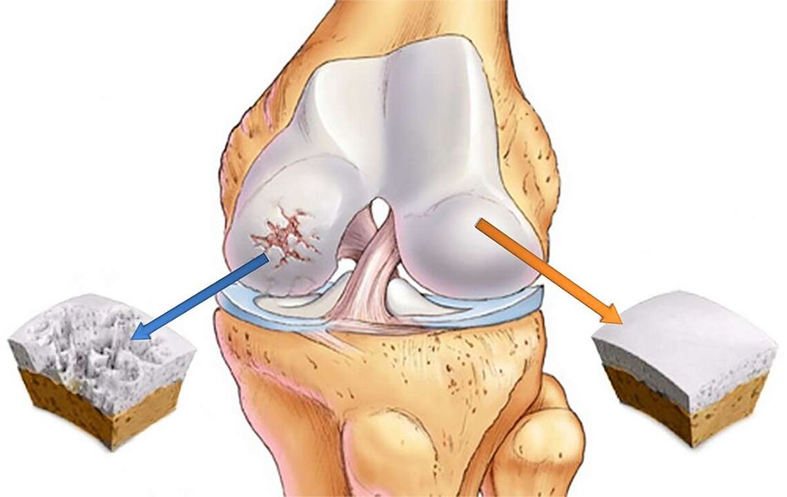Destruction of the cartilage of the knee joint with gonarthrosis. 