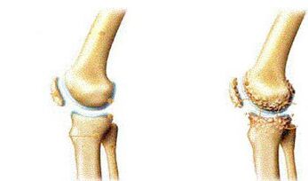 Symptoms of knee -based attractionis