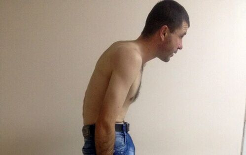Ankylosing spondylitis can cause lower back pain over the years