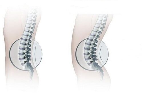 Normal spine and increased lumbar lordosis.