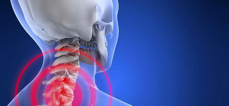 Osteochondrosis of the cervical spine.