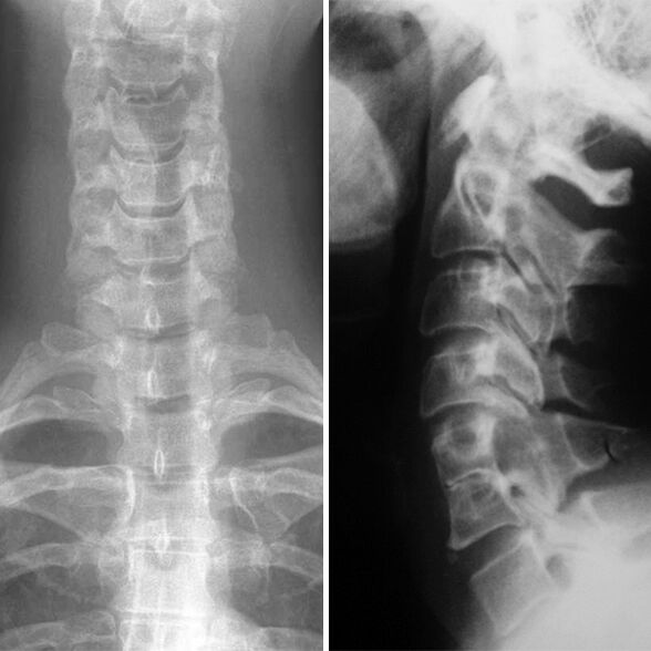 X-ray of the cervical spine.